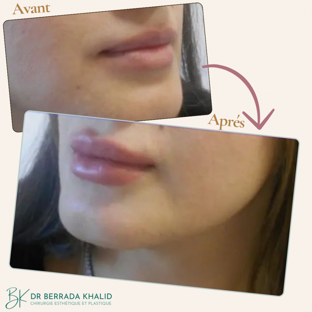 Chirurgie Visage 2 Dr Berrada Khalid - Chirurgien esthétique et plastique à Fès 12 Chirurgie Visage