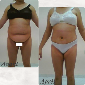 Dr Berrada Khalid - Chirurgien esthétique et plastique à Fès ABDOMINOPLASTIE dr berrada khalid photo avant apres1 10 chirurgie de la Silhouette