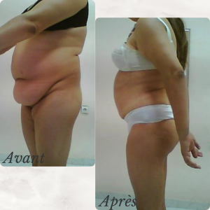 Dr Berrada Khalid - Chirurgien esthétique et plastique à Fès ABDOMINOPLASTIE dr berrada khalid photo avant apres1 12 Interventions