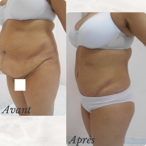 Dr Berrada Khalid - Chirurgien esthétique et plastique à Fès ABDOMINOPLASTIE dr berrada khalid photo avant apres1 15 chirurgie de la Silhouette