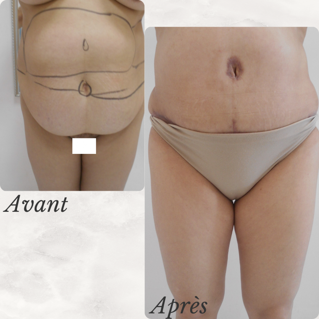 Dr Berrada Khalid - Chirurgien esthétique et plastique à Fès ABDOMINOPLASTIE dr berrada khalid photo avant apres1 19 chirurgie de la Silhouette