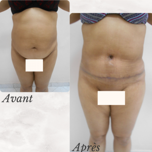Dr Berrada Khalid - Chirurgien esthétique et plastique à Fès ABDOMINOPLASTIE dr berrada khalid photo avant apres1 20 chirurgie de la Silhouette
