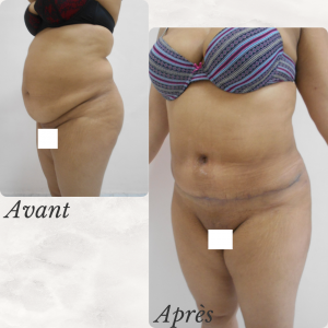 Dr Berrada Khalid - Chirurgien esthétique et plastique à Fès ABDOMINOPLASTIE dr berrada khalid photo avant apres1 21 chirurgie de la Silhouette