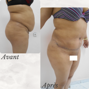Dr Berrada Khalid - Chirurgien esthétique et plastique à Fès ABDOMINOPLASTIE dr berrada khalid photo avant apres1 22 chirurgie de la Silhouette