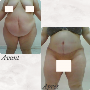 Dr Berrada Khalid - Chirurgien esthétique et plastique à Fès ABDOMINOPLASTIE dr berrada khalid photo avant apres1 23 chirurgie de la Silhouette
