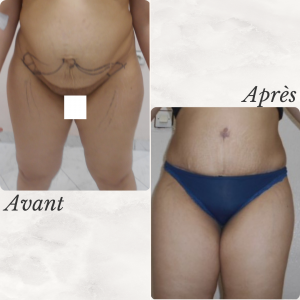 Dr Berrada Khalid - Chirurgien esthétique et plastique à Fès ABDOMINOPLASTIE dr berrada khalid photo avant apres1 4 chirurgie de la Silhouette