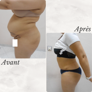 Accueil 24 Dr Berrada Khalid - Chirurgien esthétique et plastique à Fès ABDOMINOPLASTIE dr berrada khalid photo avant apres1 5 Accueil