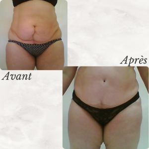 Dr Berrada Khalid - Chirurgien esthétique et plastique à Fès ABDOMINOPLASTIE dr berrada khalid photo avant apres1 7 chirurgie de la Silhouette
