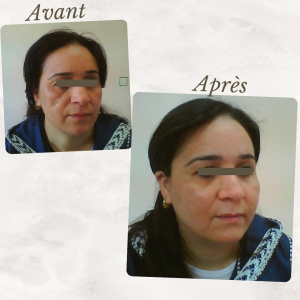 Dr Berrada Khalid - Chirurgien esthétique et plastique à Fès ATROPIES FACIALES Chirurgie réparatrice