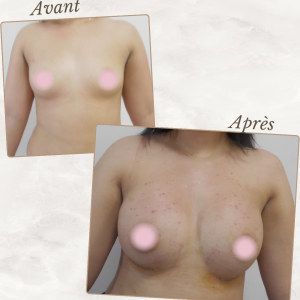 Dr Berrada Khalid - Chirurgien esthétique et plastique à Fès AUGMENTATION MAMAIRE dr berrada khalid photo avant apres1 chirurgie des Seins