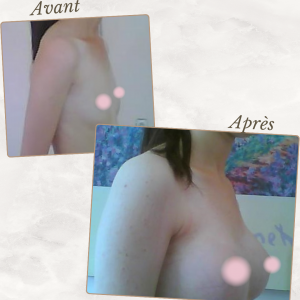 Dr Berrada Khalid - Chirurgien esthétique et plastique à Fès AUGMENTATION MAMAIRE dr berrada khalid photo avant apres11 chirurgie des Seins