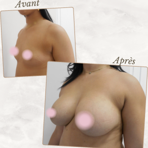 Dr Berrada Khalid - Chirurgien esthétique et plastique à Fès AUGMENTATION MAMAIRE dr berrada khalid photo avant apres16 chirurgie des Seins