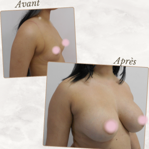 Dr Berrada Khalid - Chirurgien esthétique et plastique à Fès AUGMENTATION MAMAIRE dr berrada khalid photo avant apres17 Interventions