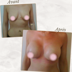 Dr Berrada Khalid - Chirurgien esthétique et plastique à Fès AUGMENTATION MAMAIRE dr berrada khalid photo avant apres18 chirurgie des Seins