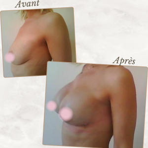 Dr Berrada Khalid - Chirurgien esthétique et plastique à Fès AUGMENTATION MAMAIRE dr berrada khalid photo avant apres19 chirurgie des Seins