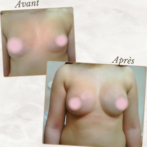 Dr Berrada Khalid - Chirurgien esthétique et plastique à Fès AUGMENTATION MAMAIRE dr berrada khalid photo avant apres2 chirurgie des Seins