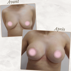 Dr Berrada Khalid - Chirurgien esthétique et plastique à Fès AUGMENTATION MAMAIRE dr berrada khalid photo avant apres25 chirurgie des Seins