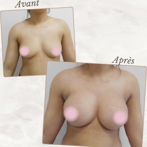 Dr Berrada Khalid - Chirurgien esthétique et plastique à Fès AUGMENTATION MAMAIRE dr berrada khalid photo avant apres26 chirurgie des Seins