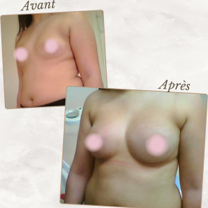 Dr Berrada Khalid - Chirurgien esthétique et plastique à Fès AUGMENTATION MAMAIRE dr berrada khalid photo avant apres3 chirurgie des Seins