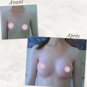 Dr Berrada Khalid - Chirurgien esthétique et plastique à Fès AUGMENTATION MAMAIRE dr berrada khalid photo avant apres9 chirurgie des Seins