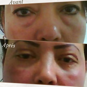 Chirurgie du visage 16 Dr Berrada Khalid - Chirurgien esthétique et plastique à Fès BLEPHAROPLASTIE dr berrada khalid photo avant apres1 Chirurgie du visage