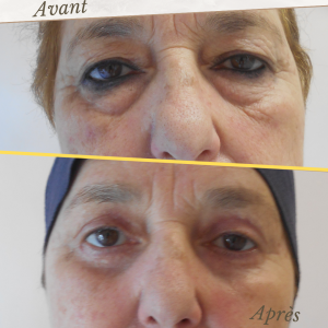 Chirurgie du visage 22 Dr Berrada Khalid - Chirurgien esthétique et plastique à Fès BLEPHAROPLASTIE dr berrada khalid photo avant apres10 Chirurgie du visage