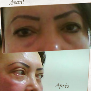 Chirurgie du visage 17 Dr Berrada Khalid - Chirurgien esthétique et plastique à Fès BLEPHAROPLASTIE dr berrada khalid photo avant apres3 Chirurgie du visage