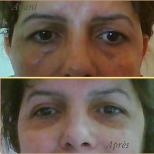 Chirurgie du visage 18 Dr Berrada Khalid - Chirurgien esthétique et plastique à Fès BLEPHAROPLASTIE dr berrada khalid photo avant apres5 Chirurgie du visage
