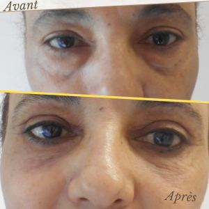 Chirurgie du visage 19 Dr Berrada Khalid - Chirurgien esthétique et plastique à Fès BLEPHAROPLASTIE dr berrada khalid photo avant apres6 Chirurgie du visage