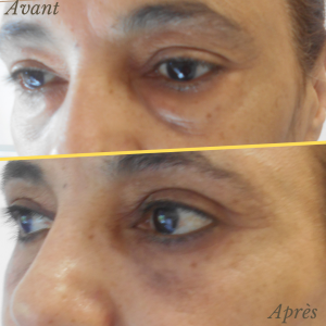 Chirurgie du visage 20 Dr Berrada Khalid - Chirurgien esthétique et plastique à Fès BLEPHAROPLASTIE dr berrada khalid photo avant apres7 Chirurgie du visage