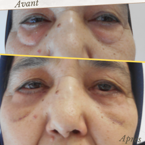 Accueil 21 Dr Berrada Khalid - Chirurgien esthétique et plastique à Fès BLEPHAROPLASTIE dr berrada khalid photo avant apres9 Accueil