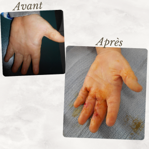 Dr Berrada Khalid - Chirurgien esthétique et plastique à Fès CHIRURGIE DE BRULES dr berrada khalid photo avant apresCHIRURGIE DE BRULES 1 Chirurgie réparatrice