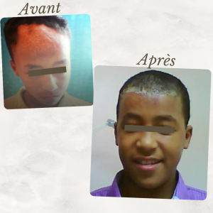 Dr Berrada Khalid - Chirurgien esthétique et plastique à Fès CHIRURGIE DE BRULES dr berrada khalid photo avant apresCopy of 7 Chirurgie réparatrice