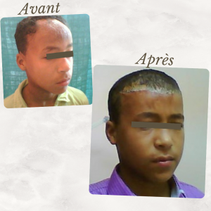 Dr Berrada Khalid - Chirurgien esthétique et plastique à Fès CHIRURGIE DE BRULES dr berrada khalid photo avant apresCopy of 8 Chirurgie réparatrice