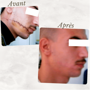 Dr Berrada Khalid - Chirurgien esthétique et plastique à Fès CICATRICES FACIALES dr berrada khalid photo avant apres10 Chirurgie réparatrice