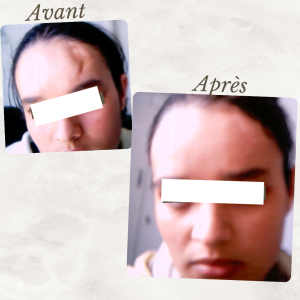 Dr Berrada Khalid - Chirurgien esthétique et plastique à Fès CICATRICES FACIALES dr berrada khalid photo avant apres3 Chirurgie réparatrice