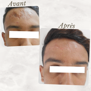 Dr Berrada Khalid - Chirurgien esthétique et plastique à Fès CICATRICES FACIALES dr berrada khalid photo avant apres4 Chirurgie réparatrice