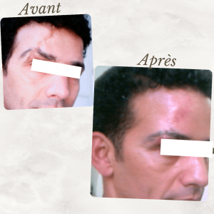 Accueil 28 Dr Berrada Khalid - Chirurgien esthétique et plastique à Fès CICATRICES FACIALES dr berrada khalid photo avant apres6 Accueil