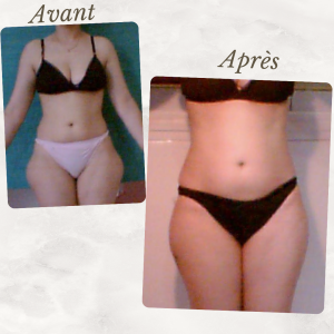 Dr Berrada Khalid - Chirurgien esthétique et plastique à Fès Culotte de chval dr berrada khalid photo avant apres1 chirurgie de la Silhouette