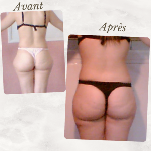 Accueil 3 Dr Berrada Khalid - Chirurgien esthétique et plastique à Fès Culotte de chval dr berrada khalid photo avant apres2 Accueil