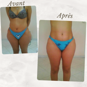Dr Berrada Khalid - Chirurgien esthétique et plastique à Fès Culotte de chval dr berrada khalid photo avant apres3 chirurgie de la Silhouette