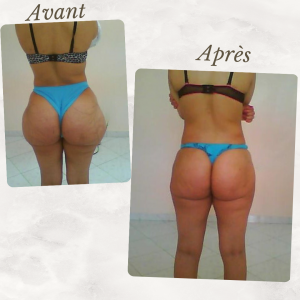 Dr Berrada Khalid - Chirurgien esthétique et plastique à Fès Culotte de chval dr berrada khalid photo avant apres4 chirurgie de la Silhouette