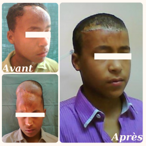 Dr Berrada Khalid - Chirurgien esthétique et plastique à Fès EXPANSION CUTANEE dr berrada khalid photo avant apres1 Chirurgie réparatrice