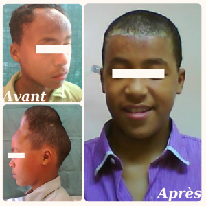 Accueil 29 Dr Berrada Khalid - Chirurgien esthétique et plastique à Fès EXPANSION CUTANEE dr berrada khalid photo avant apres2 Accueil