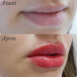 Chirurgie du visage 38 Dr Berrada Khalid - Chirurgien esthétique et plastique à Fès FILLER dr berrada khalid photo avant apres 10 Chirurgie du visage