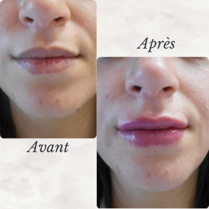 Chirurgie du visage 47 Dr Berrada Khalid - Chirurgien esthétique et plastique à Fès FILLER dr berrada khalid photo avant apres 11 Chirurgie du visage