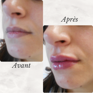 Chirurgie du visage 46 Dr Berrada Khalid - Chirurgien esthétique et plastique à Fès FILLER dr berrada khalid photo avant apres 12 Chirurgie du visage