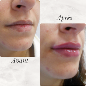 Chirurgie du visage 45 Dr Berrada Khalid - Chirurgien esthétique et plastique à Fès FILLER dr berrada khalid photo avant apres 13 Chirurgie du visage