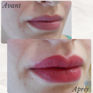 Dr Berrada Khalid - Chirurgien esthétique et plastique à Fès FILLER dr berrada khalid photo avant apres 2 Interventions