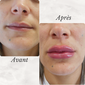 Chirurgie du visage 39 Dr Berrada Khalid - Chirurgien esthétique et plastique à Fès FILLER dr berrada khalid photo avant apres 3 Chirurgie du visage